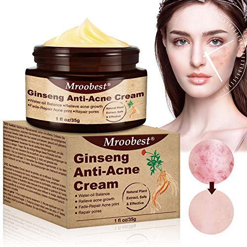 Acné Crema, Crema Antiacne, Acne Cream, Crema Para El Acné Ginseng，Equilibrio de agua y aceite, Crema contra el acné espinilla regenera la piel