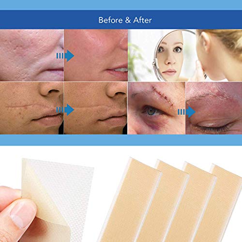 Amada pure Silicona médica de eliminación de la cicatriz extra grande hojas [5,9” x1.57” ] - rápido y eficaz en el queloide, cirugía, quemadura, 4 piezas reutilizables
