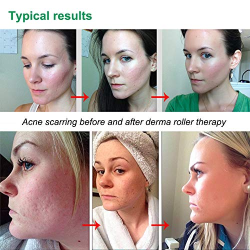 Anmyox - Rodillo dermatológico de microagujas para cara y cuerpo, 540 microagujas de titanio, con estuche de almacenamiento y rodillo de jade