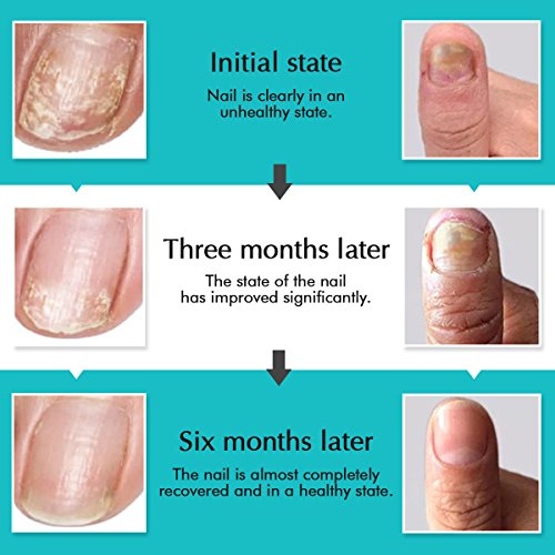 Anti Hongos Luckyfine Bolígrafo para Uñas Tratamiento Hongos Antifúngico Eficaz contra Hongo de Uñas Promueve Rebrote de Uñas Sanas Cuidado de la Reparación Natural y Seguro