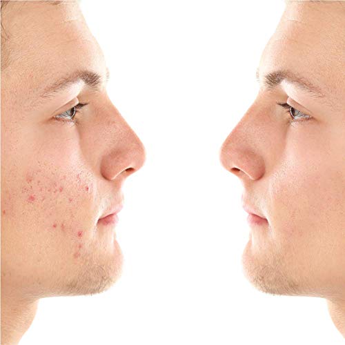 Blackhead Genius Crema de árbol de té con ácido salicílico La solución activa para los puntos negros, elimina las manchas del acné