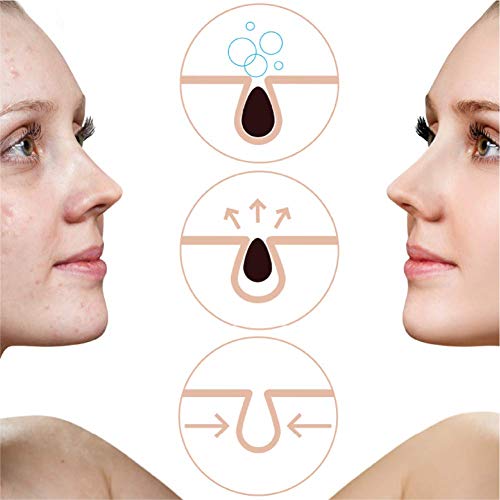 Blackhead Genius Crema de árbol de té con ácido salicílico La solución activa para los puntos negros, elimina las manchas del acné