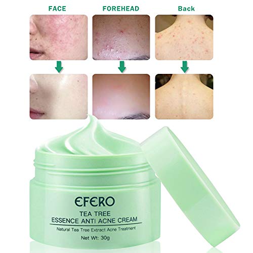Crema Antiacne, Acné Crema, Anti Acne, Acne Tratamiento, Reducir los Puntos negros, Equilibrar el Agua y el Aceite, la Crema Contra el Acné Espinilla, Regenera la piel