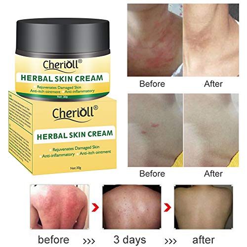 Crema para el cuerpo, tratamiento para la psoriasis, eccema, rosácea y dermatitis, la crema herbal china natural reduce la sequedad y la inflamación