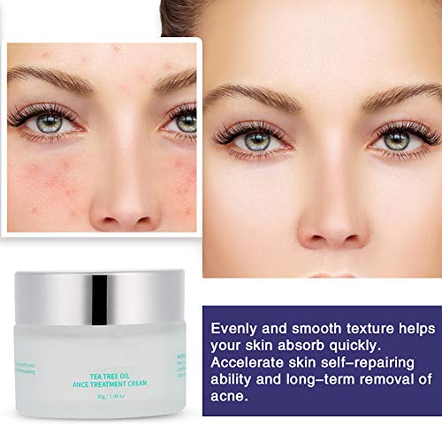 Crema Tratamiento del Acné Anti espinilla Crema para el retiro de cicatrices que blanquea el cuidado facial de la piel de la belleza, 30 g/botella