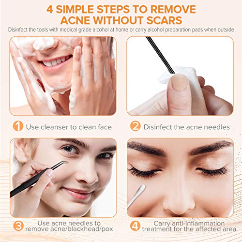 FishOaky Blackhead Remover Tool, Extractor Puntos Negros, 5 PCS Acero Inoxidable Acné Quita Espinilla Pin Spot Pimple Popper Pinzas Kit para Manchas Blancas, Manchas de Acné con Manchas