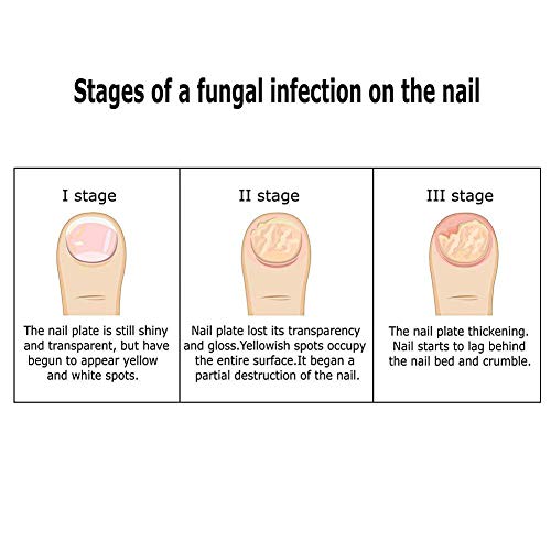 Fungus Stop,Crema Hongo Uñas Tratamiento,Anti Hongos De Uñas,Crema Tratamiento anti-hongos en las uñas,Tratamiento anti hongos de uñas,Apto para dedos y pedicura