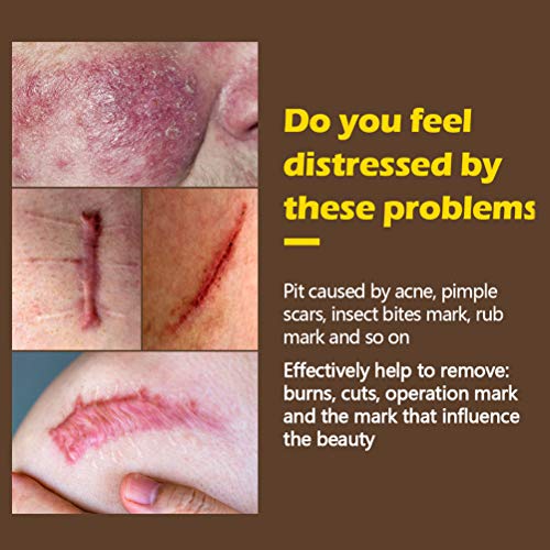 FuYouTa Crema de reparación de cicatrices Crema de cicatrices Cicatrices del acné Gel de ungüento para eliminar cicatrices y marcas de acné Cicatrices Quemaduras Cortes