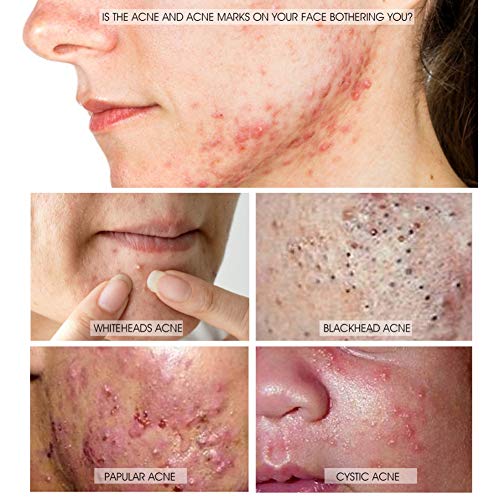 La crema reparadora para el acné Onkessy reduce rápidamente las manchas Eliminar las espinillas Reducir los poros Antiinflamatorio Crema anti-acné
