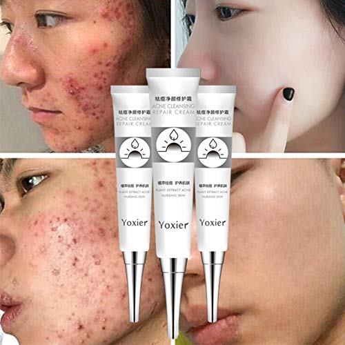 La crema reparadora para el acné Onkessy reduce rápidamente las manchas Eliminar las espinillas Reducir los poros Antiinflamatorio Crema anti-acné