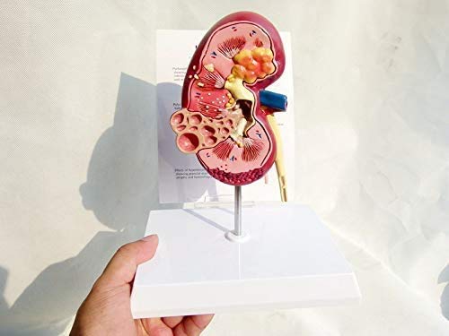 LBYLYH Riñón Humano con el Modelo Adrenal, el Modelo de Enfermedad renal con réplica de la anatomía de la Herramienta de Escritorio Medici Corporal del Paciente renal