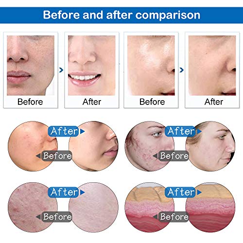 Máquina de dermoabrasión Yofuly Diamond Microdermoabrasión, uso profesional en el hogar, equipo de salón de belleza facial (potencia de succión 65-68 cmhg)