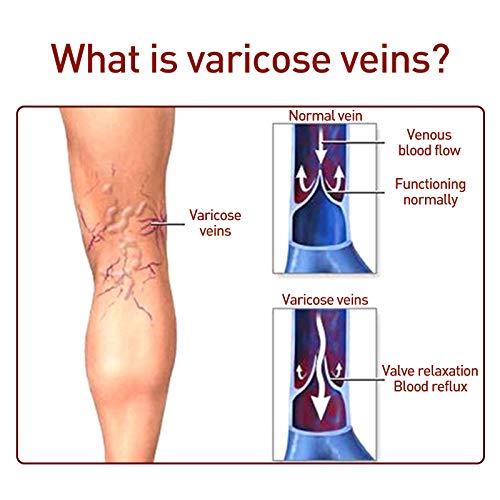 Parche Curación Venas Varicosas, Flebitis Alivio La Medicina Herbaria China Natural, Yeso Para El Tratamiento Varices Las Venas, Flebitis Alivio Para Las Piernas Hombro La Cintura Del Cuello (3BOX)