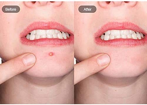 Parches Acne, Parche para acné, Acné espinilla Patch, Parches Granos, Parche absorbente de acné, Acné Hidrocoloide para Tratamiento de Espinilla - Cualquier piel (Beige)