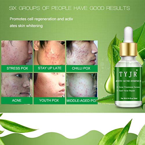 Pretty Comy Esencia de aloe vera para la eliminación de la solución del acné básica para el tratamiento antiinflamatorio de las espinillas of Control del aceite esencial del aceite hidratante