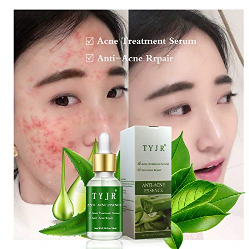 Pretty Comy Esencia de aloe vera para la eliminación de la solución del acné básica para el tratamiento antiinflamatorio de las espinillas of Control del aceite esencial del aceite hidratante