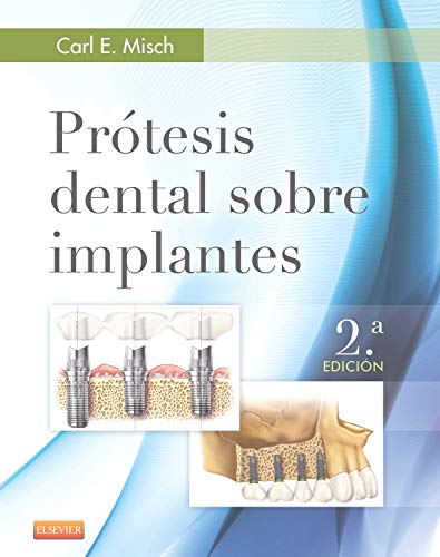 Prótesis dental sobre implantes - 2º Edición