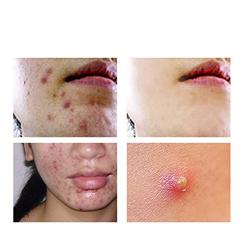 SHILLS+20% Mandelic Acid Skin Renew Essence, Vitamina E y ácido Mandelico,Remueve Acne, Arrrugas, anti enjecimiento, Iluminador facial. Esencia rejuvenecedora para la cara 30ml