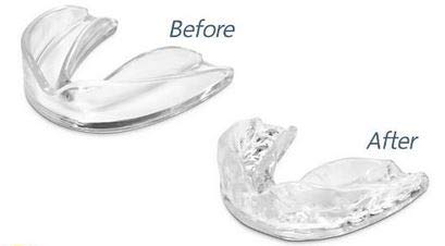 Solutions ZZZ Férula dental profesional [4 PIEZAS 2 TAMAÑOS] Ferula de Descarga Nocturna Anti rechinar de dientes- GRATIS:Libro 12 Remedios Naturales contra el Bruxismo y Estuche Antibacterial