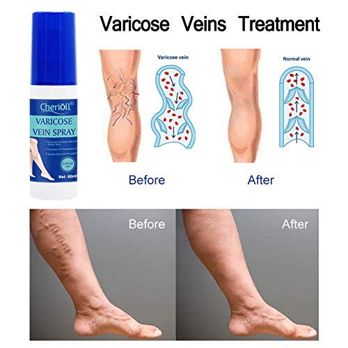 Spray de Varices, varicosa, Spray Para Varices y Piernas Cansadas e Inflamadas, Relieve Flebitis Angiitis, Inflamación, Cuidado de Piernas Suave, 60 ml