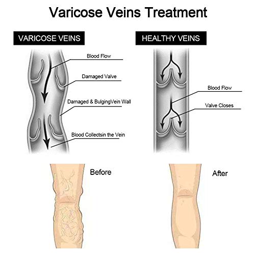 su-xuri Crema De Venas Ungüento Varicoso, Ungüento De Tratamiento De Alivio De Varices, Remedio para Las Venas Varicosas Adecuado para Estar De Pie O Usar Tacones Altos Durante Mucho Tiempo