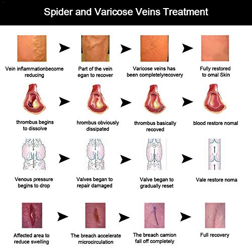 su-xuri Crema De Venas Ungüento Varicoso, Ungüento De Tratamiento De Alivio De Varices, Remedio para Las Venas Varicosas Adecuado para Estar De Pie O Usar Tacones Altos Durante Mucho Tiempo