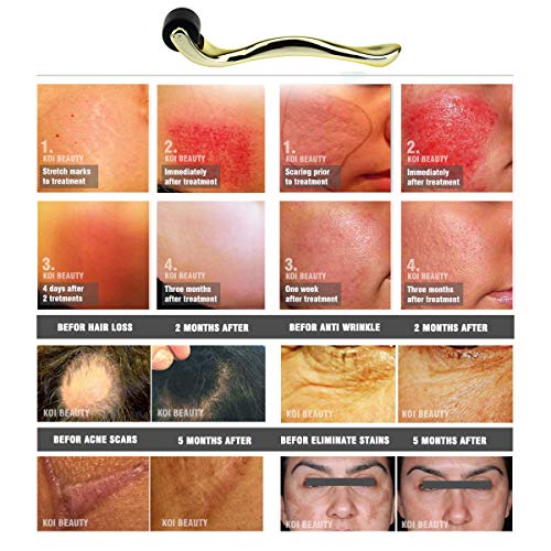 TBPHP Micro Needle Roller,540 microagujas de acero inoxidable quirúrgico de 1.0mm de grosor,Reducir la Hiperpigmentación,Reducir Ojo Líneas Finas, Crecimiento del Cabello