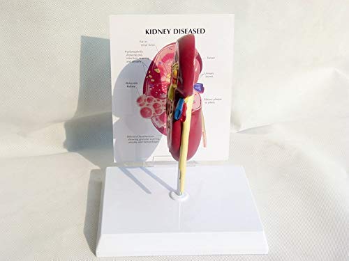 Torso Modelo Anatómico, Modelo De Riñón Humano Con Glándula Suprarrenal, Modelo De Riñón Con Patologías, Réplica De Anatomía Del Cuerpo Humano De Riñón Enfermo Para Médicos, Herramienta Educativa