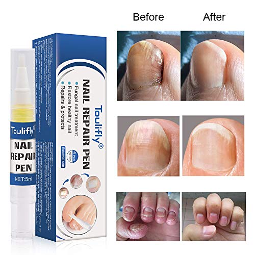 Tratamiento de Uñas, Pluma de Reparación de Uñas, tratamiento para uñas de los pies, parada de hongos, reparación de uñas, solución antihongos para uñas de los pies y uñas de los pies, 4 unidades