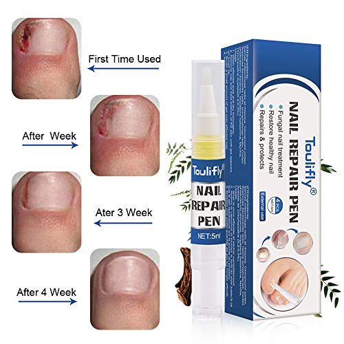 Tratamiento de Uñas, Pluma de Reparación de Uñas, tratamiento para uñas de los pies, parada de hongos, reparación de uñas, solución antihongos para uñas de los pies y uñas de los pies, 4 unidades