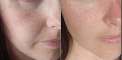 * Vitamina C y Suero de Ácido Hialurónico - Elimina las Cicatrices del Acné POTENTE Anti Envejecimiento y Anti Arrugas Serum - Cuidado de la Piel Vegano