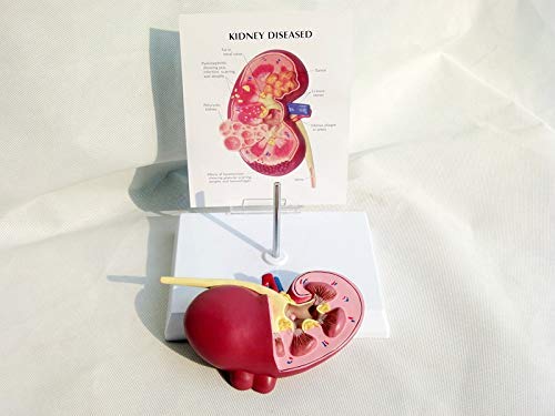 ZJHCC Riñón Humano con Modelo de glándula suprarrenal, Modelo de riñón con patologías, réplica de anatomía del Cuerpo Humano de riñón Enfermo para consultorio médico.