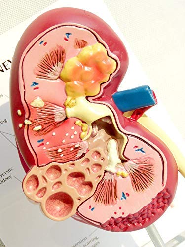 ZJHCC Riñón Humano con Modelo de glándula suprarrenal, Modelo de riñón con patologías, réplica de anatomía del Cuerpo Humano de riñón Enfermo para consultorio médico.