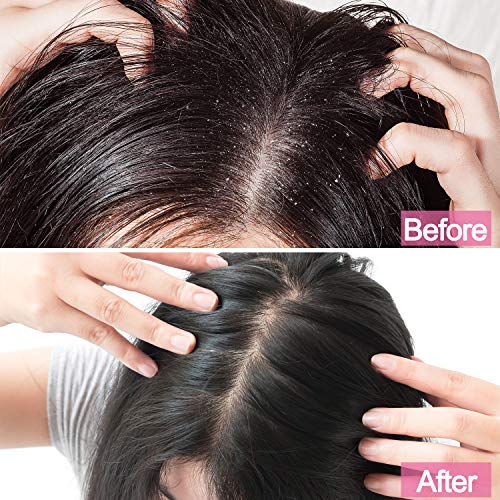 2 Masajeador de Cuero Cabelludo, Cepillo de Champú Plástico con Cabeza de Silicona para Limpiar Pelo Caspa Ducha con Cerda de Silicona Flexible para Relajar Cuero Cabelludo, Limpiar Pelo (Azul, Rosa)