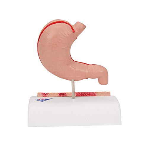 3B Scientific K17 Modelo de anatomía humana Estómago Con Úlceras Gástricas + software de anatomía gratuito - 3B Smart Anatomy