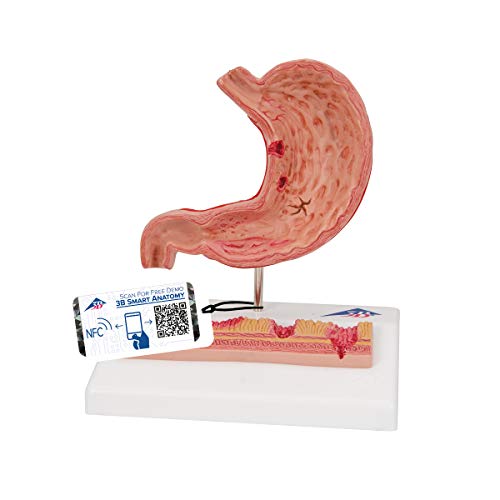 3B Scientific K17 Modelo de anatomía humana Estómago Con Úlceras Gástricas + software de anatomía gratuito - 3B Smart Anatomy