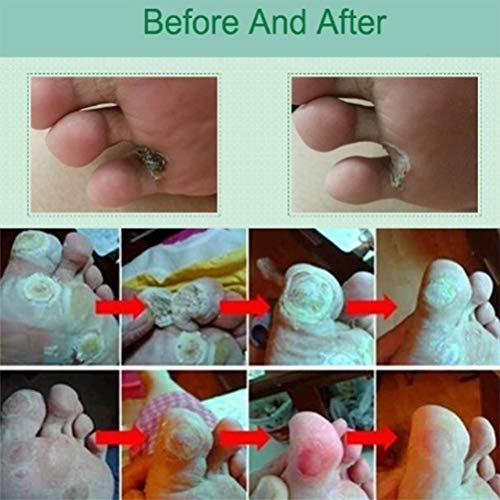 Auplew Eliminación de verrugas Eliminador de Piel de eliminación de Marcas de Nacimiento de 5 ml, Tratamiento de verrugas Líquido eliminador de verrugas