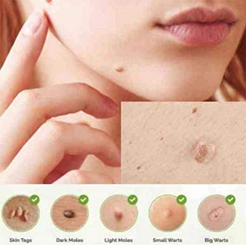 Auplew Eliminación de verrugas Eliminador de Piel de eliminación de Marcas de Nacimiento de 5 ml, Tratamiento de verrugas Líquido eliminador de verrugas