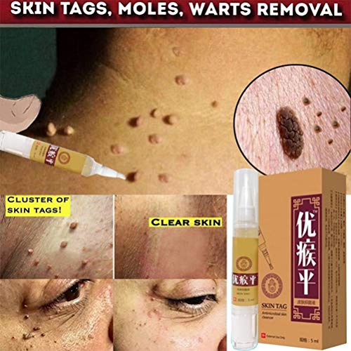 Auplew Eliminación de verrugas Eliminador de Piel de eliminación de Marcas de Nacimiento de 5 ml, Tratamiento de verrugas Líquido eliminador de verrugas