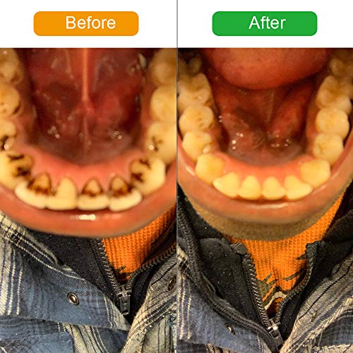 Cepillos de Dientes, ifanze Limpieza Dental Cepillos Dentales, Limpieza de los Dientes Bucal Limpiador con 5 Modos de Cepillado, 4 Recambio Cabezales kit Limpieza Dental 5 in 1