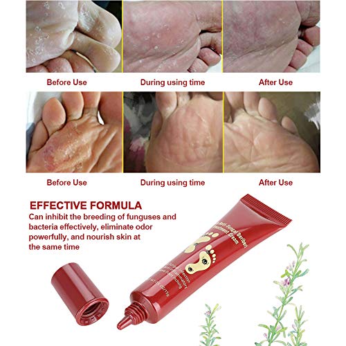 Crema antimicótica para el cuidado de los pies Ungüento natural para calmar la picazón, escamación o agrietamiento de la piel Inhibir hongos, bacterias y eliminar el olor