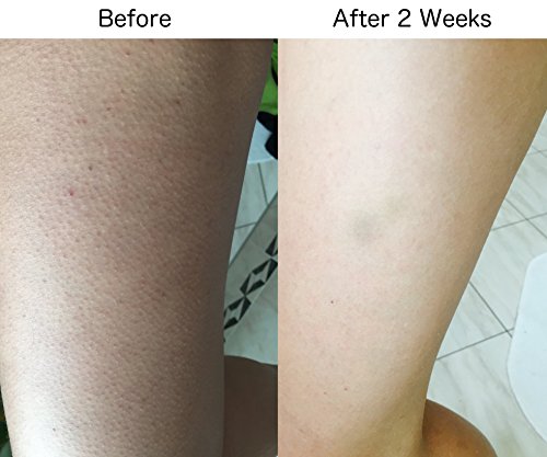 Crema de tratamiento para queratosis pilaris e hiperqueratosis con resultados excelentes