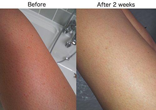 Crema de tratamiento para queratosis pilaris e hiperqueratosis con resultados excelentes