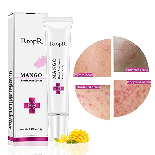 Crema para el acné, Crema para el acné, Crema para el tratamiento del acné, Crema para el tratamiento de la cicatriz del acné, Crema contra el acné, Crema antipinilla, Equilibrio con agua y aceite