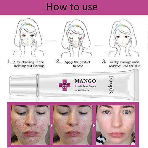 Crema para el acné, Crema para el acné, Crema para el tratamiento del acné, Crema para el tratamiento de la cicatriz del acné, Crema contra el acné, Crema antipinilla, Equilibrio con agua y aceite