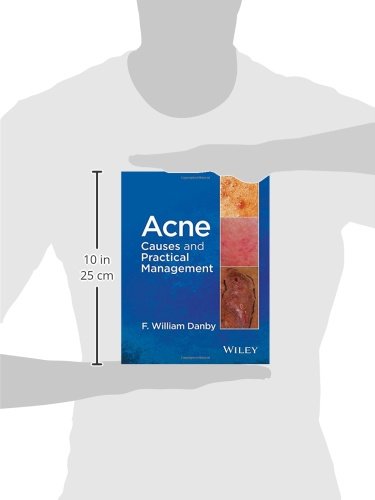 Danby, F: Acne: Causes and Practical Management