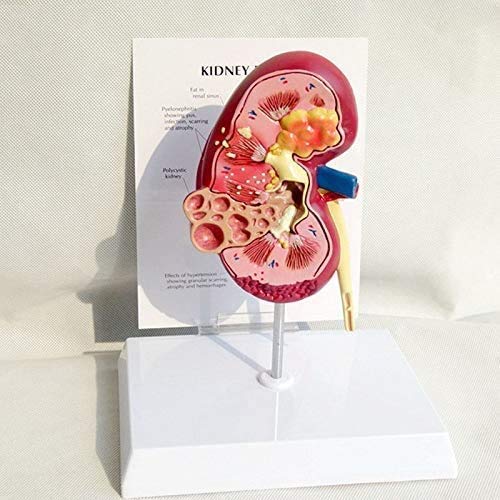 Educación Riñón Humano con Modelo suprarrenal, Modelo de riñón con Enfermedades, réplica de la anatomía del Cuerpo Humano Riñón Enfermo para Office Tool Medici