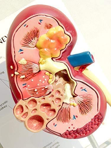Educación Riñón Humano con Modelo suprarrenal, Modelo de riñón con Enfermedades, réplica de la anatomía del Cuerpo Humano Riñón Enfermo para Office Tool Medici