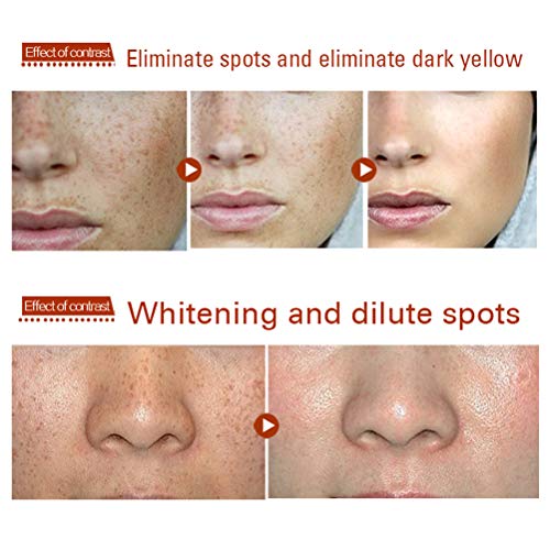 Egosy Crema blanqueadora Anti Manchas manchadas Crema Crema para el Rostro Crema para Manchas de la Edad/Manchas oscuras