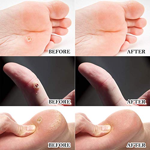 Eliminador de verrugas, tratamiento de eliminación de verrugas, removedor de maíz, almohadillas de ácido salicílico para la eliminación tópica de callos callosos o verrugas plantares （36 piezas）